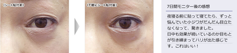Photo:ビフォーアフター お悩み:小ジワ・たるみ